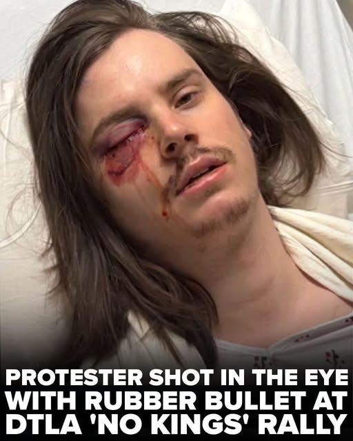 Protester shot in the eye with rubber bullet during ‘No Kings Day’ rally in downtown Los Angeles