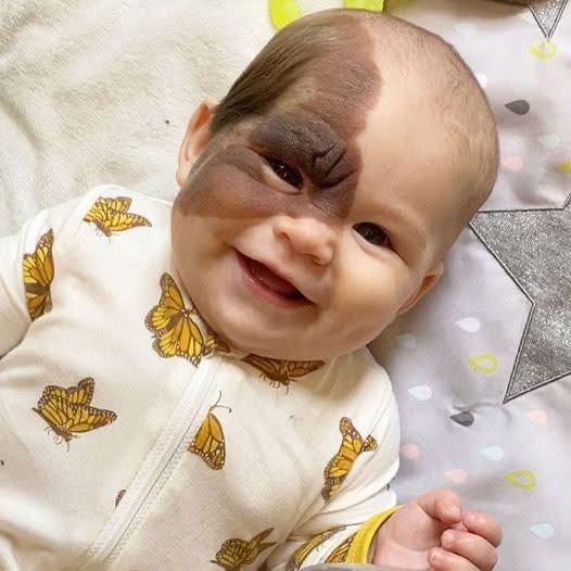 Parents’ Love Inspires Life-Changing Choice to Help Daughter With Rare Birthmark 💕