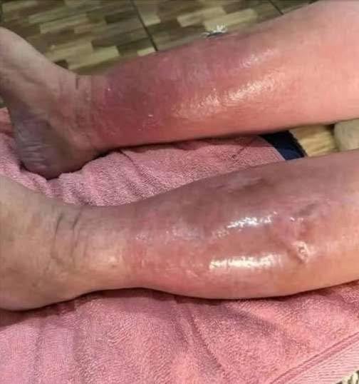 Swollen Feet? Here’s What Your Body Could Be Trying to Tell You