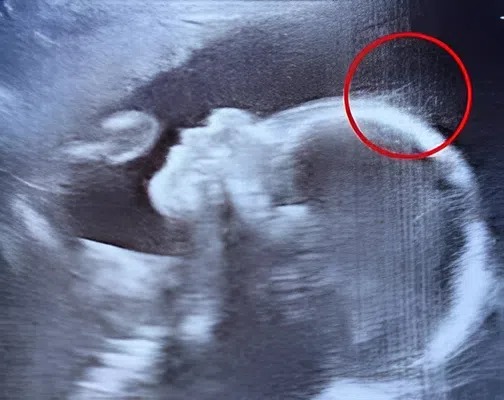 Doctors couldn’t believe what they saw during the ultrasound. But when the baby girl was born, her charm, strength, and story touched hearts around the world in the most unexpected way.
