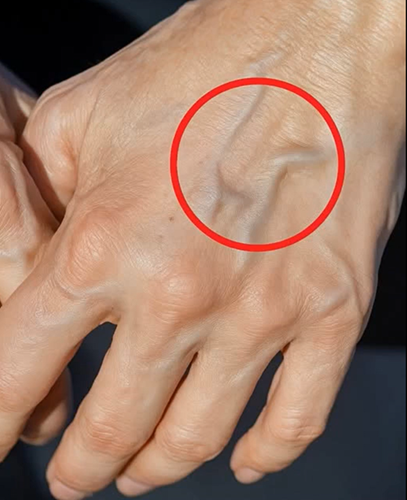 What Causes Sudden Bulging Veins—and When to Worry