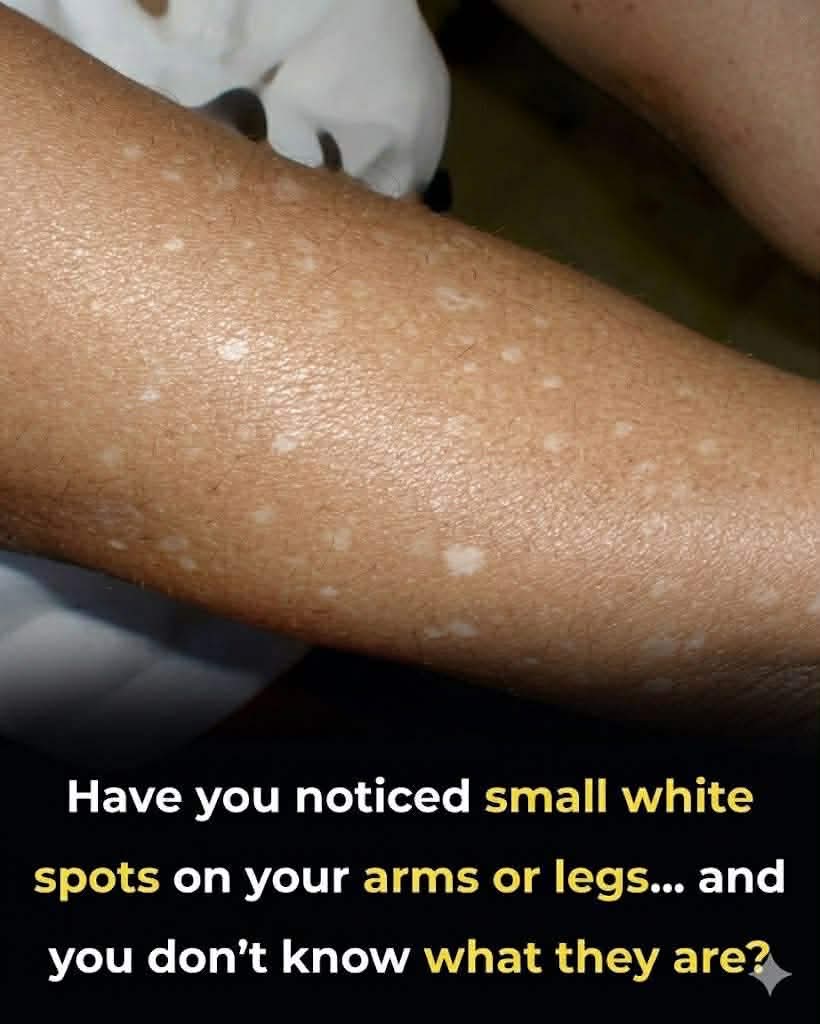 Doctors Reveal The Truth Behind Those Tiny White Spots On Your Skin