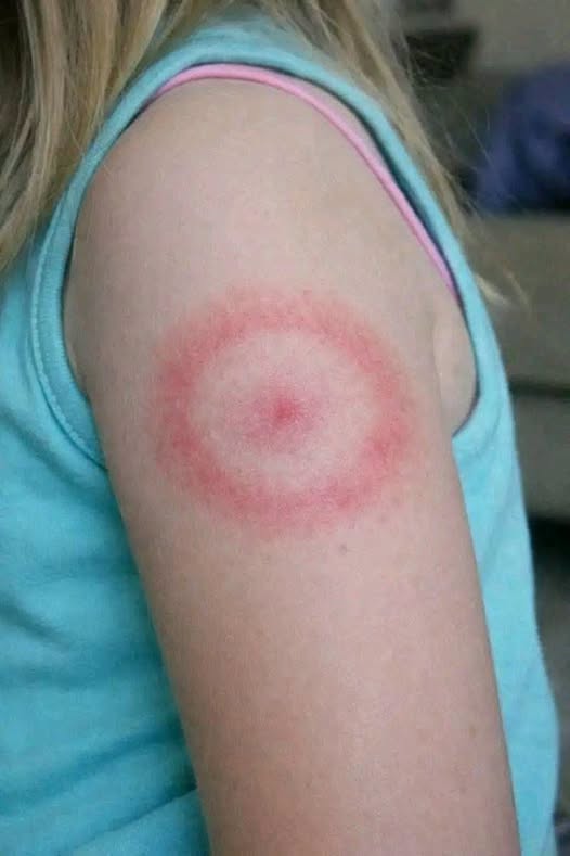 The Strange Red Ring on My Daughter’s Arm That Sent Me Into a Panic