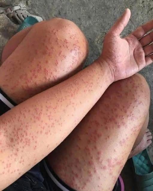 The Dangerous Reaction That Can Start With What Looks Like Just A Simple Rash